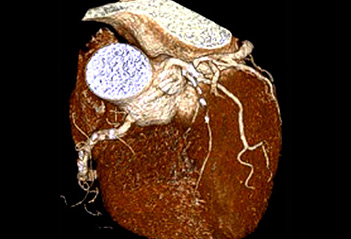 64-SLICE CT