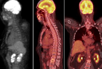 PET SCAN